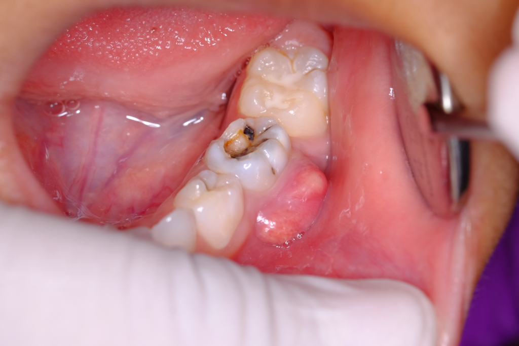 Baby tooth with Abscess Dr.Imneet